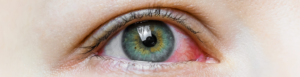 rood oog
